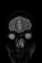 Cerebral arteriovenous malformation at posterior body of corpus callosum (Radiopaedia 74111-84925 Coronal T2 14).jpg