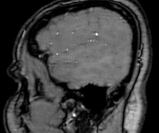 Cerebral arteriovenous malformation at posterior body of corpus callosum (Radiopaedia 74111-84925 J 29).jpg