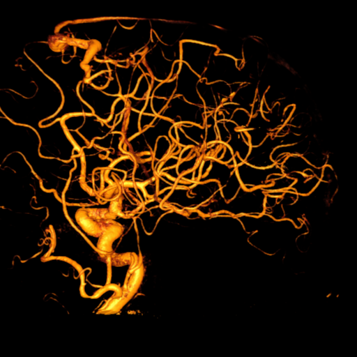 Cerebral arteriovenous malformation with lobar hemorrhage (Radiopaedia 44725-48513 Lateral 33).png
