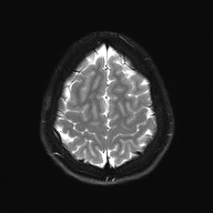 Cerebral cavernous venous malformation (Radiopaedia 70008-80021 Axial DWI 26).jpg