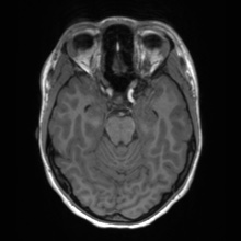 Cerebral cavernous venous malformation (Radiopaedia 70008-80021 Axial T1 25).jpg