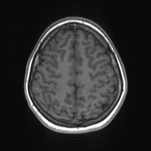 Cerebral cavernous venous malformation (Radiopaedia 70008-80021 Axial T1 67).jpg