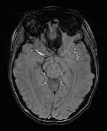 Cerebral cavernous venous malformation (Radiopaedia 70008-80021 I 31).jpg