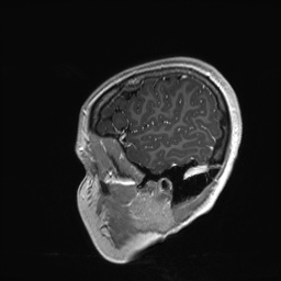 File:Cerebral cavernous venous malformation (Radiopaedia 70008-80021 Sagittal T1 C+ 63).jpg