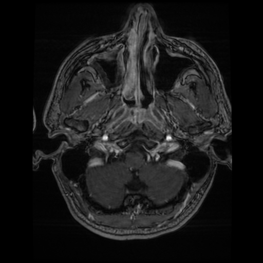 Cerebral cavernous venous malformation (Zabramski type II) (Radiopaedia 85511-101198 Axial T1 C+ fat sat 73).jpg