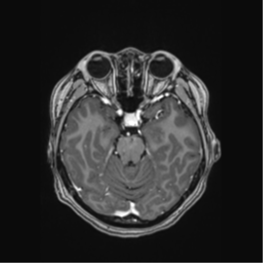 Cerebral cavernous venous malformations (Radiopaedia 48117-52946 Axial T1 C+ 18).png