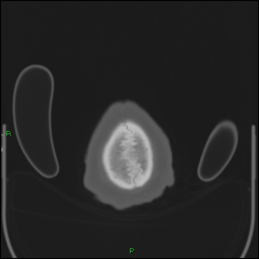 Cerebral contusions (Radiopaedia 33868-35039 Axial bone window 221).jpg