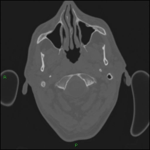 Cerebral contusions (Radiopaedia 33868-35039 Axial bone window 4).jpg