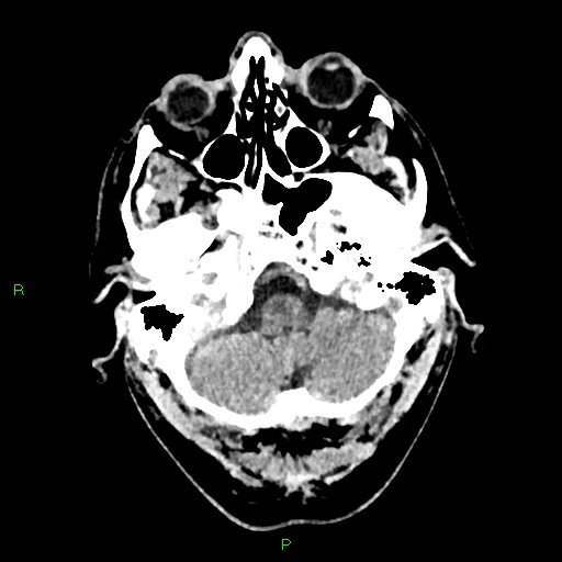 Cerebral contusions (Radiopaedia 33868-35039 Axial non-contrast 29).jpg