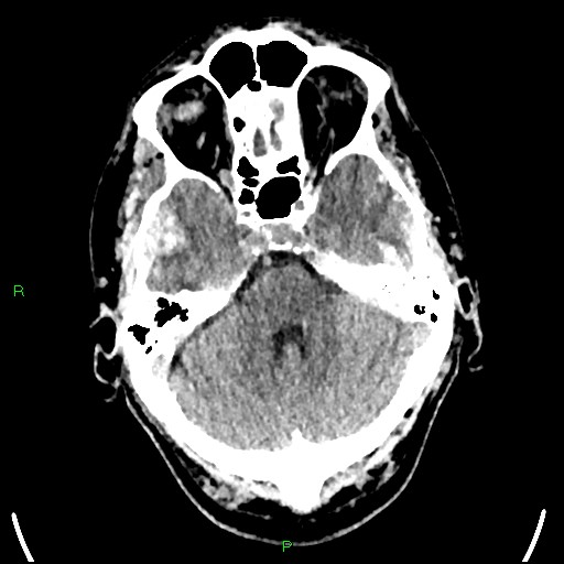 Cerebral contusions (Radiopaedia 33868-35039 Axial non-contrast 57).jpg