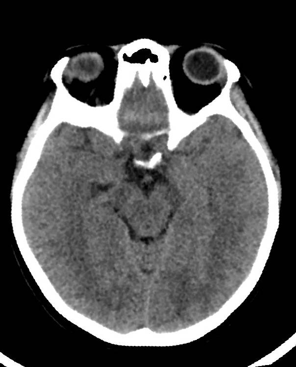 Cerebral edema due to severe hyponatremia (Radiopaedia 89826-106938 Axial non-contrast 43).jpg