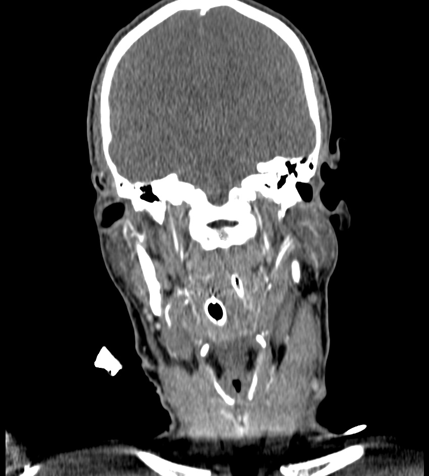 Cerebral edema in an overdose patient (Radiopaedia 72005-82539 B 63).jpg