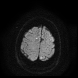 Cerebral embolic infarcts (embolic shower) (Radiopaedia 49837-55108 Axial DWI 56).jpg