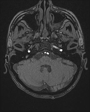 Cerebral embolic infarcts (embolic shower) (Radiopaedia 72391-82921 Axial MRA 17).jpg