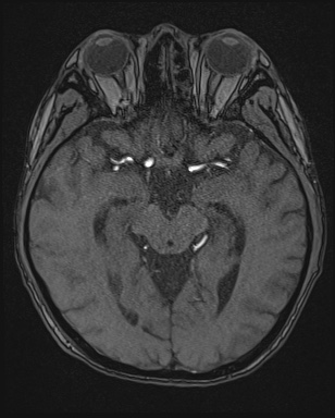 Cerebral embolic infarcts (embolic shower) (Radiopaedia 72391-82921 Axial MRA 68).jpg