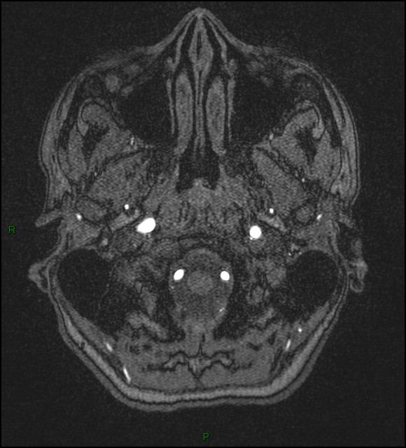 Cerebral fat embolism (Radiopaedia 35022-36525 Axial TOF 7).jpg