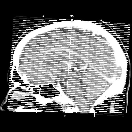 Cerebral hemorrhage secondary to arteriovenous malformation (Radiopaedia 33497-34561 B 1).png