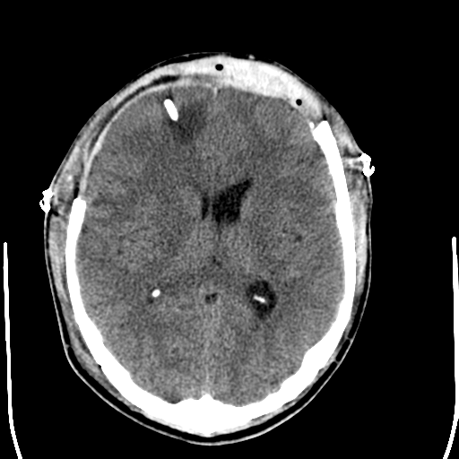 File:Cerebral hemorrhagic contusions- temporal evolution (Radiopaedia 40224-42755 AXIAL THICK 17).png
