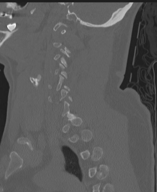 Cerebral hemorrhagic contusions and cervical spine fractures (Radiopaedia 32865-33841 Sagittal bone window 34).jpg