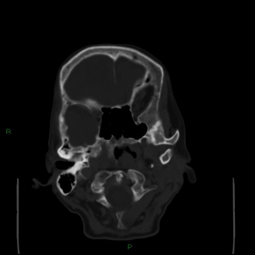 Cerebral metastases - breast primary (Radiopaedia 77653-89857 Axial bone window 20).jpg