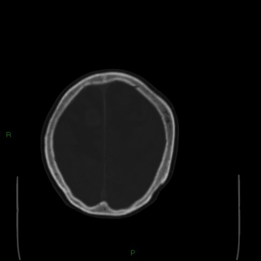 Cerebral metastases - breast primary (Radiopaedia 77653-89857 Axial bone window 94).jpg