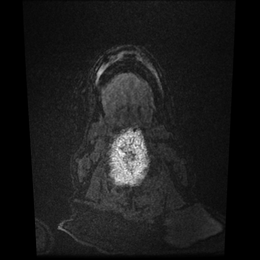 Cerebral metastases - melanoma (Radiopaedia 80972-94522 Axial T1 C+ 94).jpg