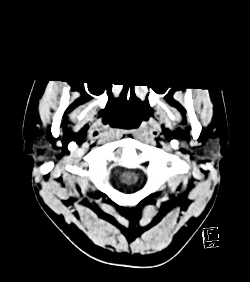 Cerebral metastases - testicular choriocarcinoma (Radiopaedia 84486-99855 Axial C+ delayed 53).jpg