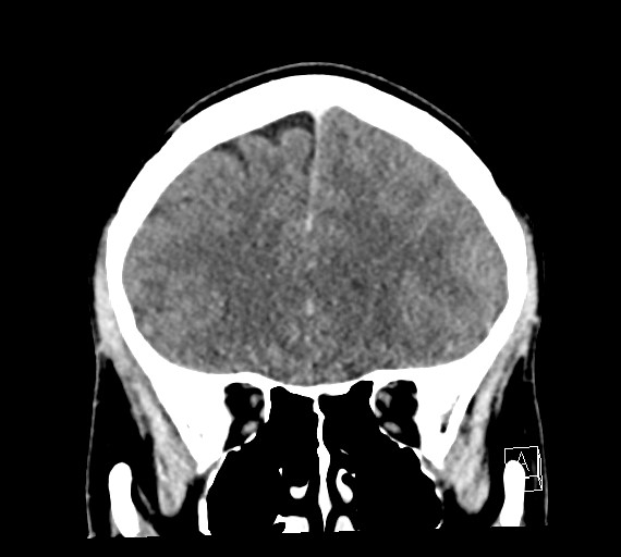 Cerebral metastases - testicular choriocarcinoma (Radiopaedia 84486-99855 D 19).jpg