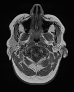 File:Cerebral metastases mimicking abscesses (Radiopaedia 45841-50131 Axial T1 2).png