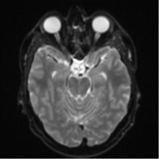 Cerebral metastasis - colorectal adenocarcinoma (Radiopaedia 50394-55765 Axial DWI 9).png