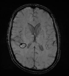 File:Cerebral metastasis - melanoma (Radiopaedia 54718-60954 Axial SWI 32).png
