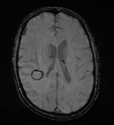File:Cerebral metastasis - melanoma (Radiopaedia 54718-60954 Axial SWI 34).png