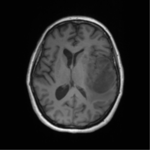 Cerebral metastasis mimicking glioblastoma (Radiopaedia 69155-78937 Axial T1 36).png