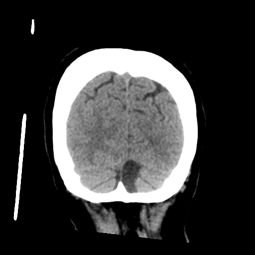 Cerebral metastasis to basal ganglia (Radiopaedia 81568-95412 Coronal non-contrast 57).png