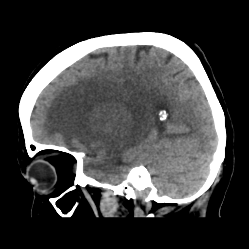 File:Cerebral metastasis to basal ganglia (Radiopaedia 81568-95412 E 22).png