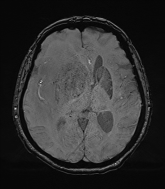 File:Cerebral metastasis to basal ganglia (Radiopaedia 81568-95413 Axial SWI 44).png