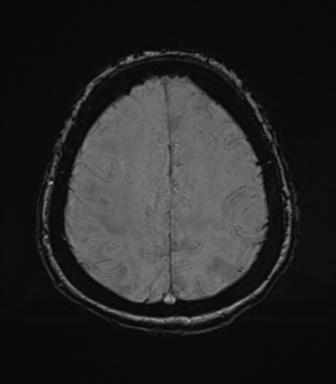 Cerebral metastasis to basal ganglia (Radiopaedia 81568-95413 Axial SWI 69).png