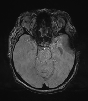 Cerebral metastasis to basal ganglia (Radiopaedia 81568-95413 Axial SWI magnitude 29).png