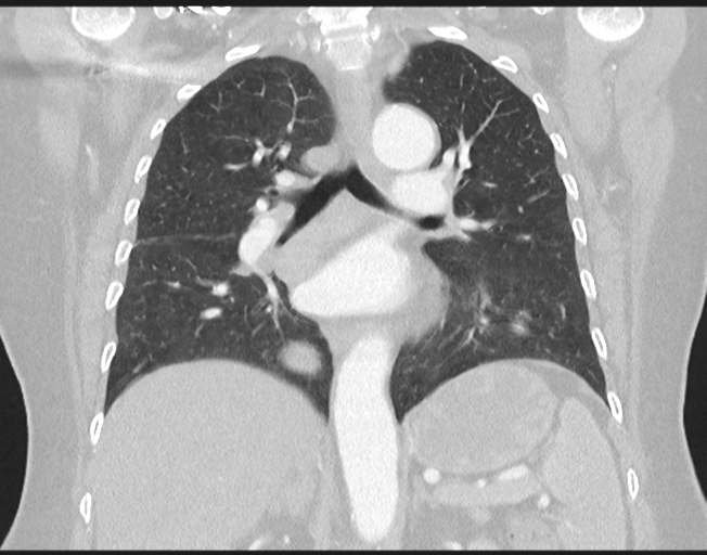 File:Cerebral metastasis to basal ganglia (Radiopaedia 81568-95414 Coronal lung window 50).png