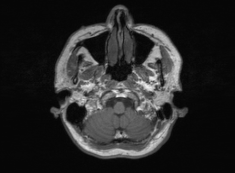 Cerebral ring enhancing lesions - cerebral metastases (Radiopaedia 44922-48817 Axial T1 343).jpg
