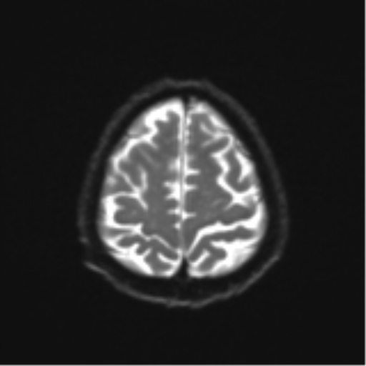 File:Cerebral toxoplasmosis (Radiopaedia 54575-60804 Axial DWI 27).png