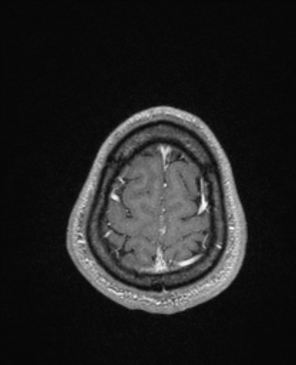 Cerebral toxoplasmosis (Radiopaedia 85779-101597 Axial T1 C+ 145).jpg