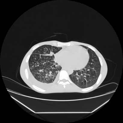 Cerebral tuberculoma (Radiopaedia 80829-94318 Axial lung window 120).jpg
