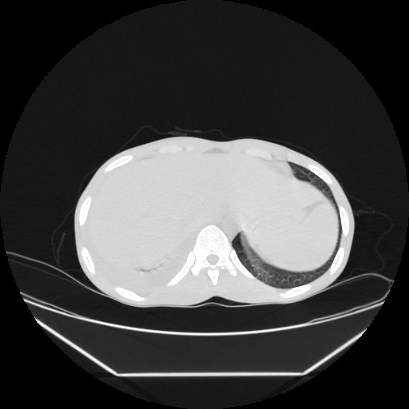 Cerebral tuberculoma (Radiopaedia 80829-94318 Axial lung window 170).jpg