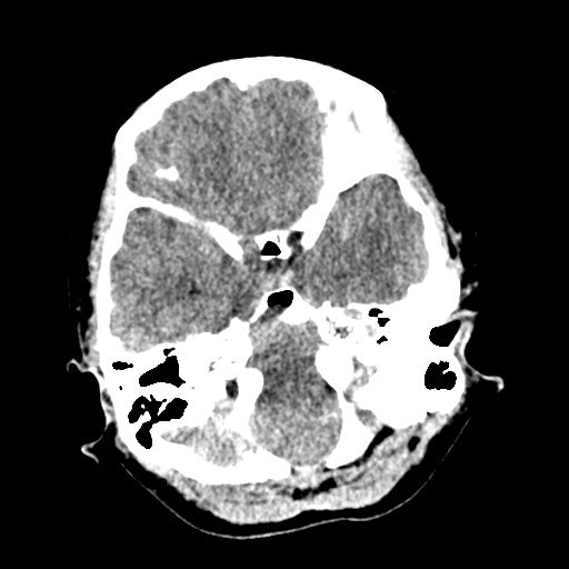 Cerebral tuberculosis with dural sinus invasion (Radiopaedia 60353-68018 Axial non-contrast 11).jpg