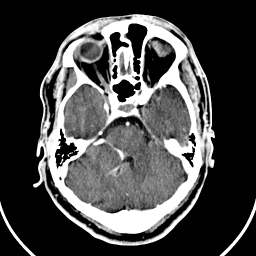 File:Cerebral venous angioma (Radiopaedia 69959-79977 B 17).jpg