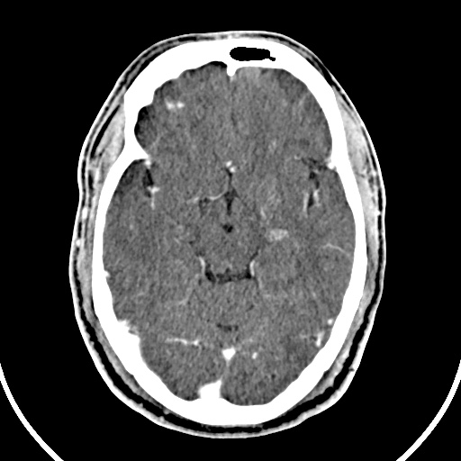 Cerebral venous angioma (Radiopaedia 69959-79977 B 31).jpg