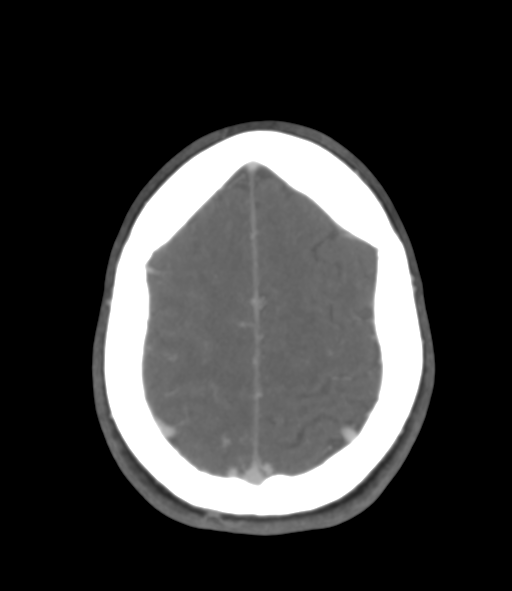 Cerebral venous hemorrhagic infarction (Radiopaedia 38461-40550 Axial MIP VENOGRAM 43).png