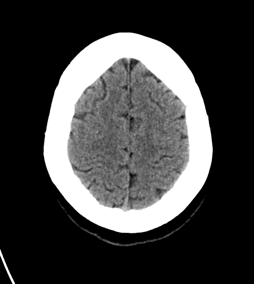 File:Cerebral venous infarct related to dural venous sinus thromboses (Radiopaedia 35292-36804 Axial non-contrast 24).png