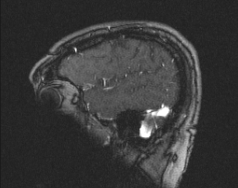 Cerebral venous infarction (Radiopaedia 65166-74176 Sagittal TOF 60).jpg